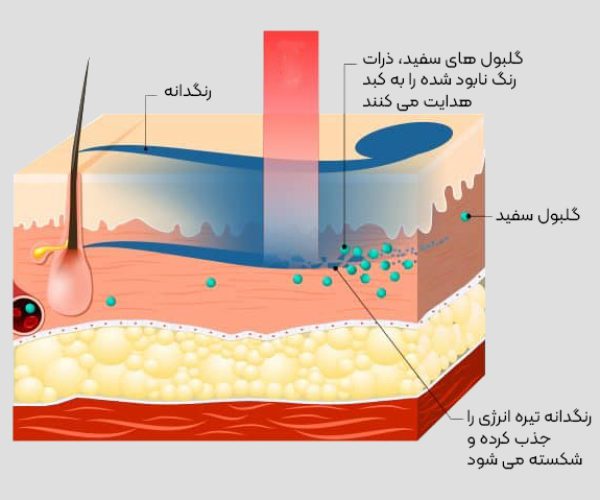 laser-tattoo-removal-shiraz